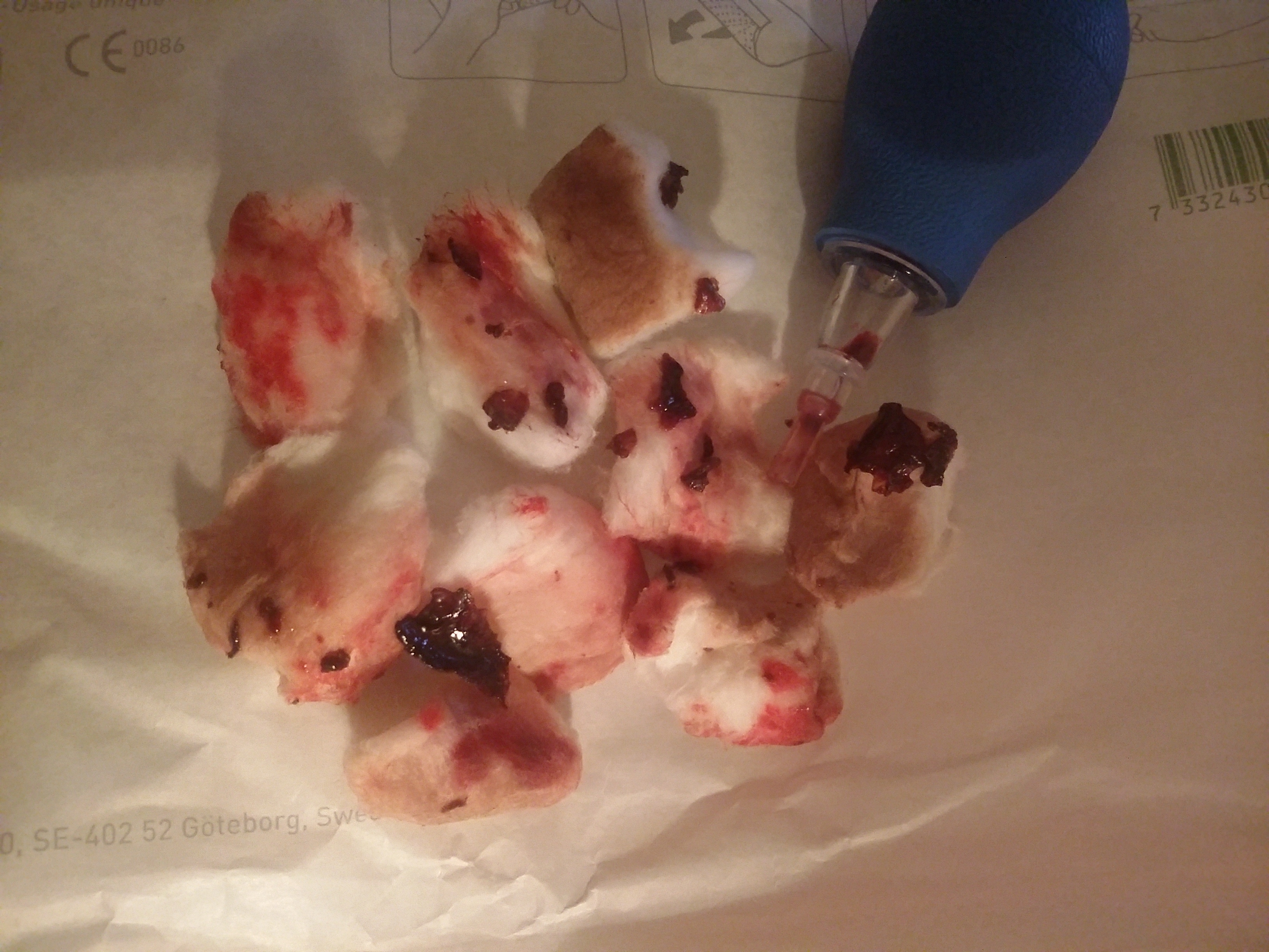 Bloodied cotton balls and syringe used to clean baby's face. 